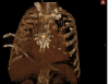 Thorax 10 Angio.PNG